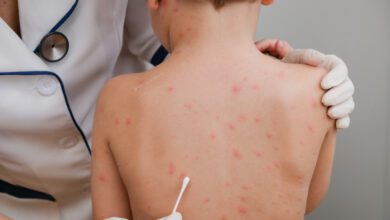 فيروس جدري القرود