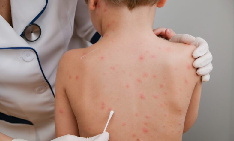 فيروس جدري القرود